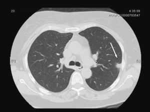 Nódulo pulmonar subpleural atribuido a embolia séptica.