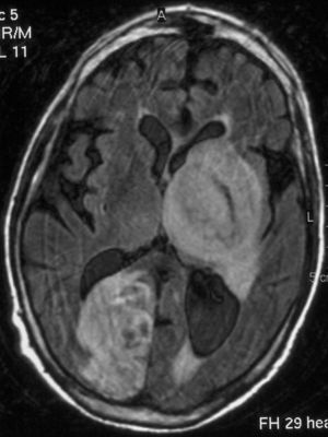 Resonancia magnética craneal (secuencia FLAIR [Fluid Attenuated Inversion Recovery ‘recuperación de inversión con atenuación de fluido’]): absceso ganglionar basal izquierdo y occipital derecho.