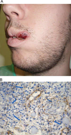 A) Lesión nodular con superficie erosionada cubierta de costra serosa, localizada en el labio superior adyacente a la comisura bucal. B) Inmunohistoquímica (técnica con impregnación argéntica). Se demuestra una gran cantidad de espiroquetas (señaladas con flechas).
