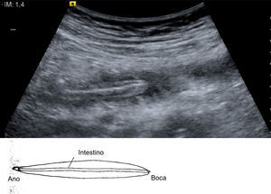 Ecografía abdominal que muestra una imagen compatible con un helminto en el interior de un asa intestinal.