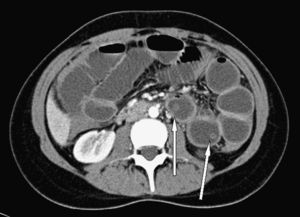 Tomografía computarizada abdominal que muestra asas de intestino delgado dilatadas, con una estructura intraluminar tubular en el yeyuno proximal (flechas).