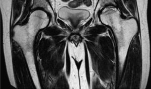 Osteonecrosis de cadera izquierda estadio IC de la ARCO27, central y lateral.