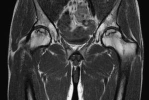 Osteonecrosis de cadera bilateral, estadio IB de la ARCO27.