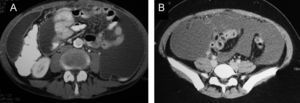 TAC abdominal. A) Ascitis tabicada con engrosamiento peritoneal y epiploico (caso 4). B) Ascitis libre (caso 7).