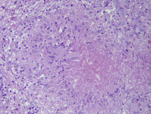 Biopsia peritoneal: granulomas caseificantes con presencia de células epitelioides y células gigantes de tipo Langhans.