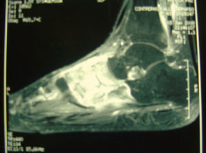 Primera resonancia magnética del pie derecho: “osteomielitis del tarso con afectación del mediopié y articulación tarsometatarsiana con masa de partes blandas abscesificada en el margen lateral del pie”.