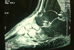 Segunda resonancia magnética del pie derecho: “alteración de la esponjosa ósea en huesos cortos tarsianos y bases de metatarsianos, con afectación difusa de escafoides, cuñas y gran parte de cuboides. Se aprecian zonas de adelgazamiento cortical y aumento de partes blandas en la región dorsal, hallazgos compatibles con extensa osteomielitis”.