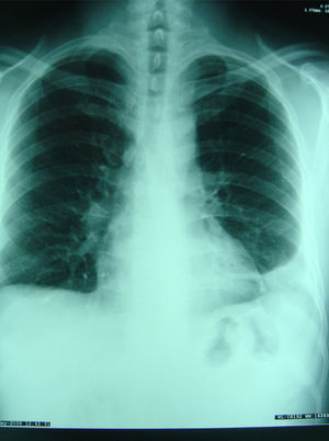 Radiografía de tórax: derrame pleural izquierdo.