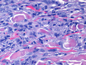 Histiocitos con inclusiones intracitoplasmáticas teñidas con Giemsa compatibles con leishmanias.