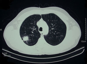 Corte axial de la tomografía axial computarizada de tórax, donde se observa un nódulo de 2,8cm de diámetro con infiltrado perilesional.