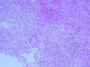 Células gigantes multinucleadas que forman granulomas mal definidos. Biopsia cutánea. Hematoxilina-eosina (×400).