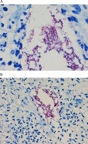 Tinción de Ziehl-Neelsen de la biopsia cutánea. Obsérvense los bacilos resistentes al ácido y al alcohol. A) ×400; B) ×1.000.