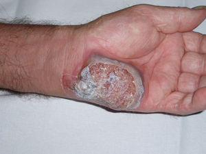 Aspecto de la lesión: placa ulcerada con borde gris-violáceo en mano izquierda.