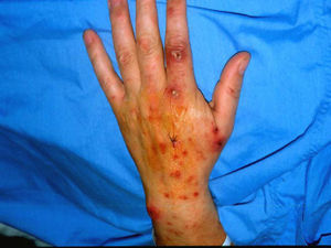 Lesiones en distintos estadios en el dorso de la mano izquierda y en la zona de biopsia.