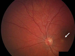 Fondo de ojo: lesión blanquecina ligeramente sobreelevada paramacular (zona inferior, haz papilomacular) en ojo izquierdo.