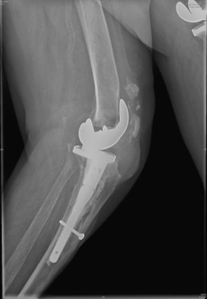 Radiografía de la rodilla izquierda.