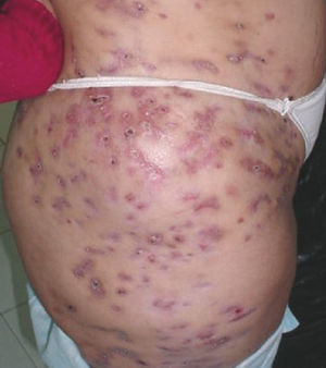 Paciente con lesiones en la piel sobre extremidades y abdomen, causadas por infección con Mycobacterium abscessus.