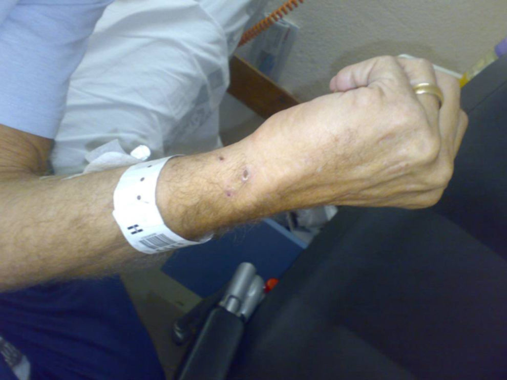 se puede transmitir la meningitis de los perros a los humanos