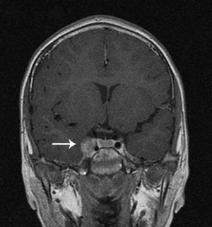 MRI after 8 weeks of treatment: no evidence of right sinus cavernous thrombosis, with pseudoaneurysm of the right intracavernous carotid artery.