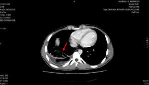 TAC torácico en el que se observa nódulo cavitado en la base derecha pulmonar que se ha abierto a la cavidad pleural evidenciándose hidropioneumotórax.