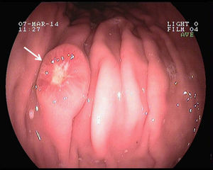 Gastroscopia. Se aprecia un nódulo en cuerpo gástrico de color púrpura y centro umbilicado (flecha).