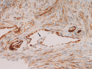 Estudio anatomopatológico [×40]. Tinción inmunohistoquímica con CD34. Proliferación vascular y de células fusiformes en lámina propia de mucosa gástrica, compatible con sarcoma de Kaposi. Se observan espacios vasculares dilatados e irregulares, algunos de ellos rodeando un vaso preexistente («signo del promontorio») (flecha).