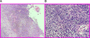 Microfotografía de biopsia de cuello uterino, teñida con técnica de Hematoxilina Eosina. A) Histoarquitectura distorsionada con ulceración del epitelio de revestimiento y reemplazo por material fibrino supurativo. Corion subyacente edematoso y congestivo, con focos de abscedación e intenso infiltrado inflamatorio (100×). B) Intenso infiltrado inflamatorio mixto a predominio polimorfonuclear, rico en detritus celulares con compromiso de las paredes vasculares (vasculitis) (200×).
