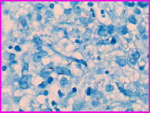 Microfotografía de biopsia de cuello uterino, teñida con técnica de Ziehl Neelsen. Estructuras bacilares dispersas, delgadas, rectas o ligeramente curvas y de extremos redondeados, de 1 a 4μm de longitud. Los bacilos se destacan como bastones de color rojo brillante a magenta sobre el fondo tisular azul (600×).