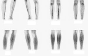 Gammagrafía ósea de miembros inferiores con signos de periostitis tibial y peronea bilateral.