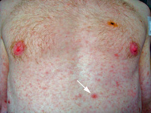 Rash cutáneo morbiliforme diseminado y lesiones ulceradas con centro necrótico en tronco (flecha) y extremidades.