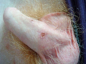 Lesión ulcerada con centro necrótico de 0,5cm de diámetro en base del pene.