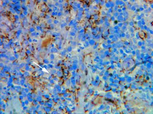 Biopsia cutánea con tinción de inmunohistoquímica que muestra la presencia de abundantes treponemas en epidermis (flecha) y paredes vasculares.