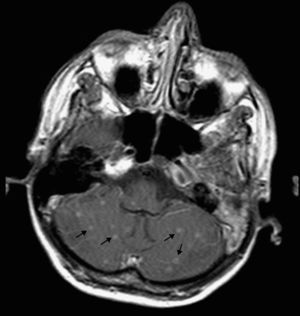 Resonancia magnética cerebral que muestra la presencia de múltiples lesiones nodulares infracentrimétricas infratentoriales en parénquima cerebral, isointensas y con realce en anillo tras la administración de contraste (flechas negras), sin signos de meningitis.
