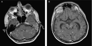 Resonancia magnética cerebral de control evolutivo que muestra aumento paradójico de tamaño de las lesiones cerebrales parenquimatosas en cerebelo (a) y hemisferios cerebrales (b) con captación periférica en anillo correspondientes a tuberculomas en el contexto de síndrome inflamatorio de reconstitución inmune.