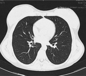 TC torácica inicial que muestra ausencia de afectación pulmonar en lóbulos inferiores.