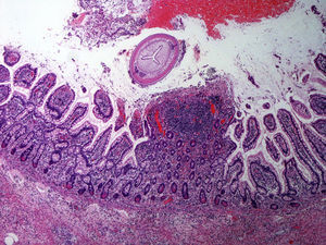 Histología de pared intestinal con oxiuro en su luz.