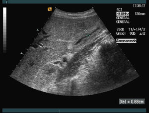 Image of the abdominal ultrasound performed on the third day of admission. The wall of the gallbladder was thickened (approximately 1 centimetre).