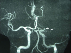 Angiorresonancia que muestra oclusión completa de la arteria cerebral media izquierda.