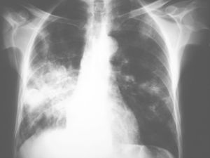 Radiografía de tórax con condensación pulmonar en el lóbulo inferior derecho e infiltrados en los lóbulos superior e inferior izquierdos.