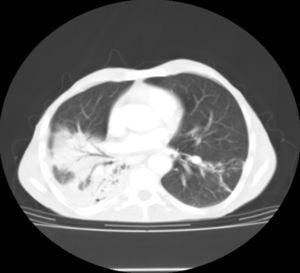 Tomografía computarizada que demuestra la condensación pulmonar, con broncograma aéreo, en el lóbulo inferior derecho.
