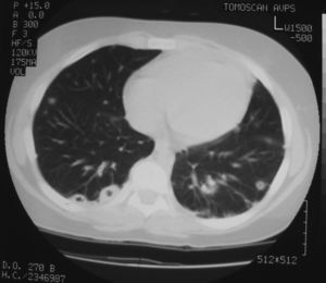 TC pulmonar que muestra imágenes nodulares y cavitaciones de pequeño tamaño compatibles con émbolos sépticos.