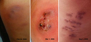Clinical evolution of the lesions.