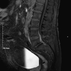 RM de columna vertebral ponderada en T1 con supresión grasa tras administración de contraste. Colección epidural de 3,4×2,9cm en sentidos craneocaudal y anteroposterior, colección de psoas-ilíaco izquierdo de 5,5×0,8cm, y afección de los platillos inferior de L5 y superior de S1 en su región posterior.