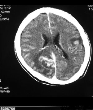 TAC craneal con contraste iv que muestra varias lesiones focales en ambos hemisferios cerebrales, hiperdensas por sangrado de las mismas, que realzan tras contraste intravenoso y que asocian edema vasogénico.