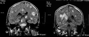 Resonancia magnética cerebral que muestra la presencia de múltiples lesiones focales supra e infratentoriales, algunas de ellas con signos de hemorragia.
