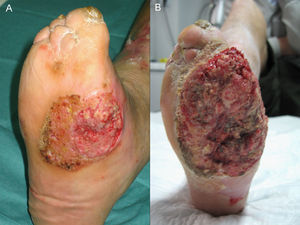 Úlcera plantar con tejido de granulación al mes de iniciar tratamiento local (A) y posterior desarrollo de reacción pseudohiperepiteliomatosa (B). Un mes de diferencia entre ambas imágenes.