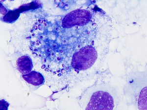 Abundantes levaduras de intracelulares en aspirado de médula ósea teñido con Giemsa.
