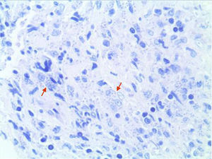 Amastigotes intracelulares (tinción de Giemsa).