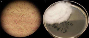 Biopsia cutánea. a. Tinción de hematoxicilina-eosina. b. Cultivo en Sabouraud-dextrosa.