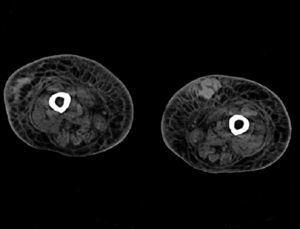 Tomografía computarizada de miembros inferiores: múltiples imágenes hiperdensas en tejido celular subcutáneo compatibles con hematomas.
